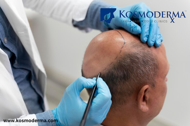  Hair Transplant Cost in Delhi | Affordable & Expert Hair Restoration at Kosmoderma