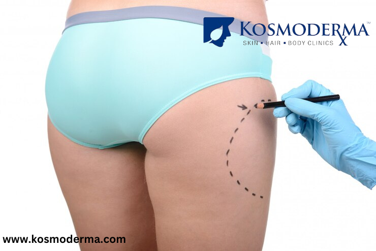  Brazilian Butt Lift Surgery In Bangalore - Kosmoderma Skin Clinic