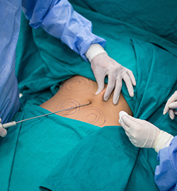  Best Liposuction Surgery Clinic in Ahmedabad