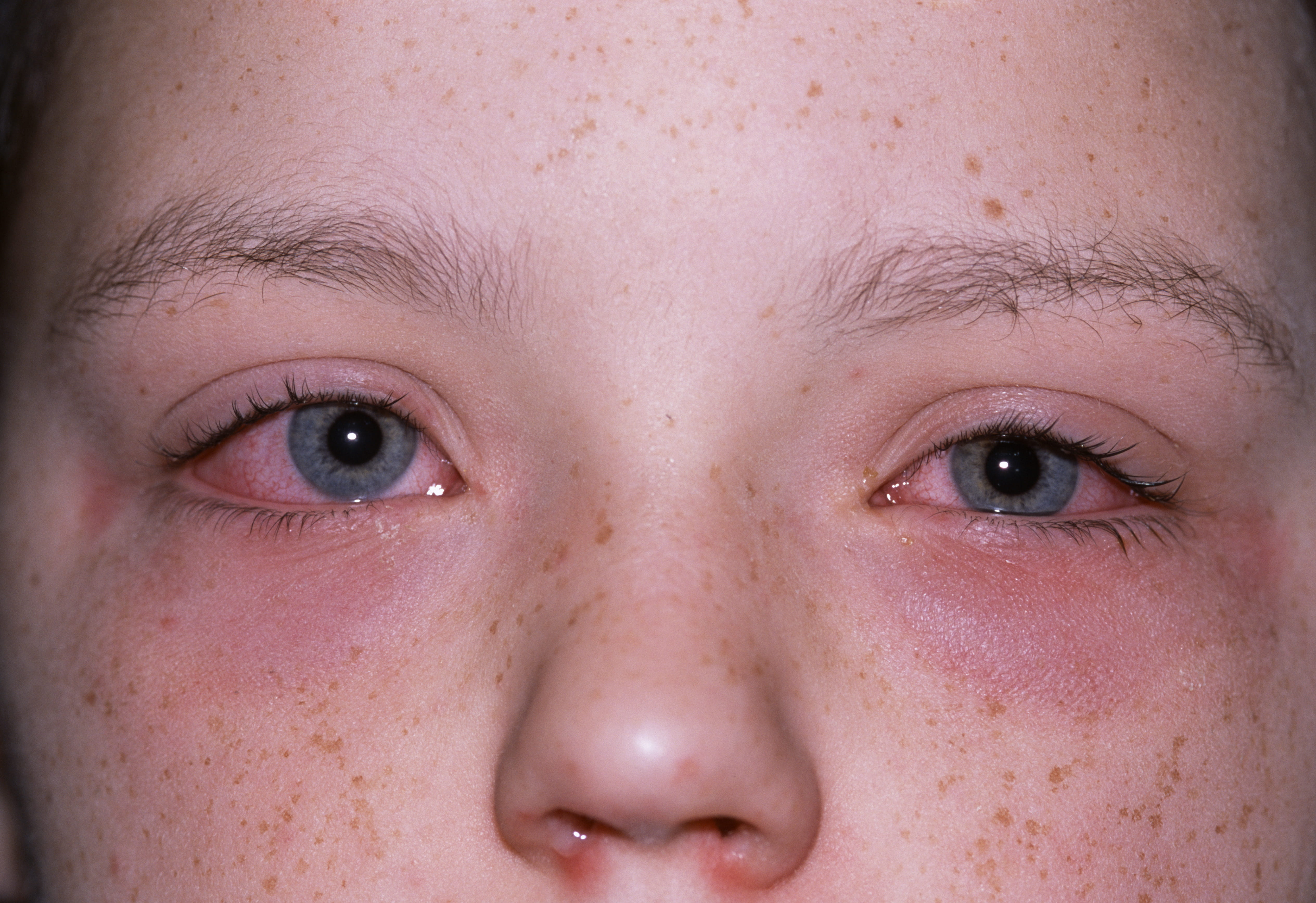  Allergic conjunctivitis