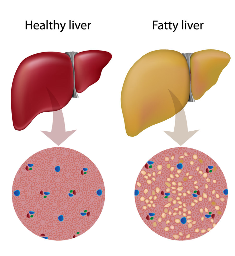  Explore Natural Treatment Options For Fatty Liver Relief