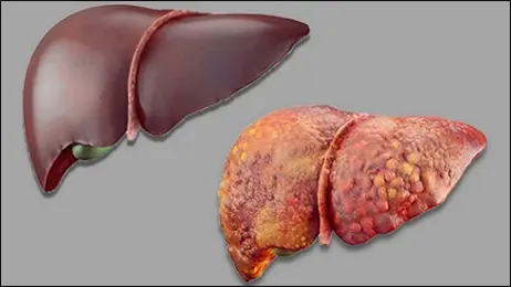  Liver Disease? Discover Ayurvedic Treatment Options