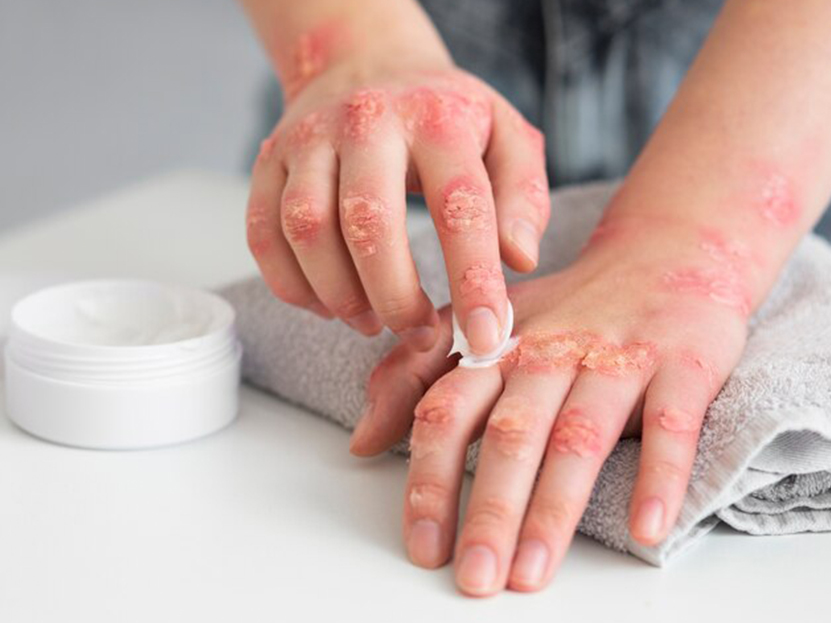  Psoriasis Treatment in Pune