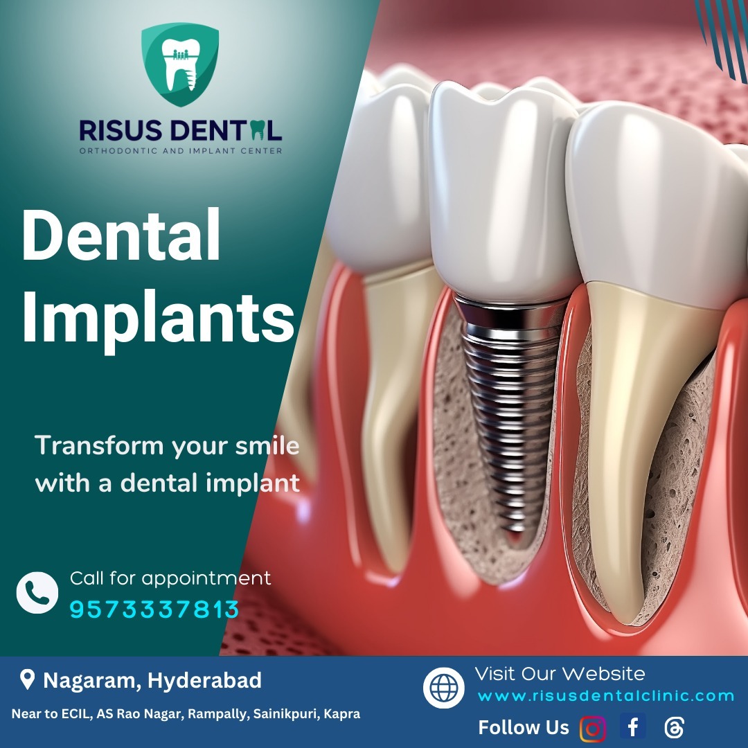  BEST DENTAL IMPLANT CENTRE IN NAGARAM , HYDERABAD | RISUS DENTAL CLINIC