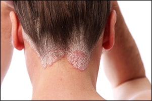  Ayurvedic And Alternative Treatment For Psoriasis