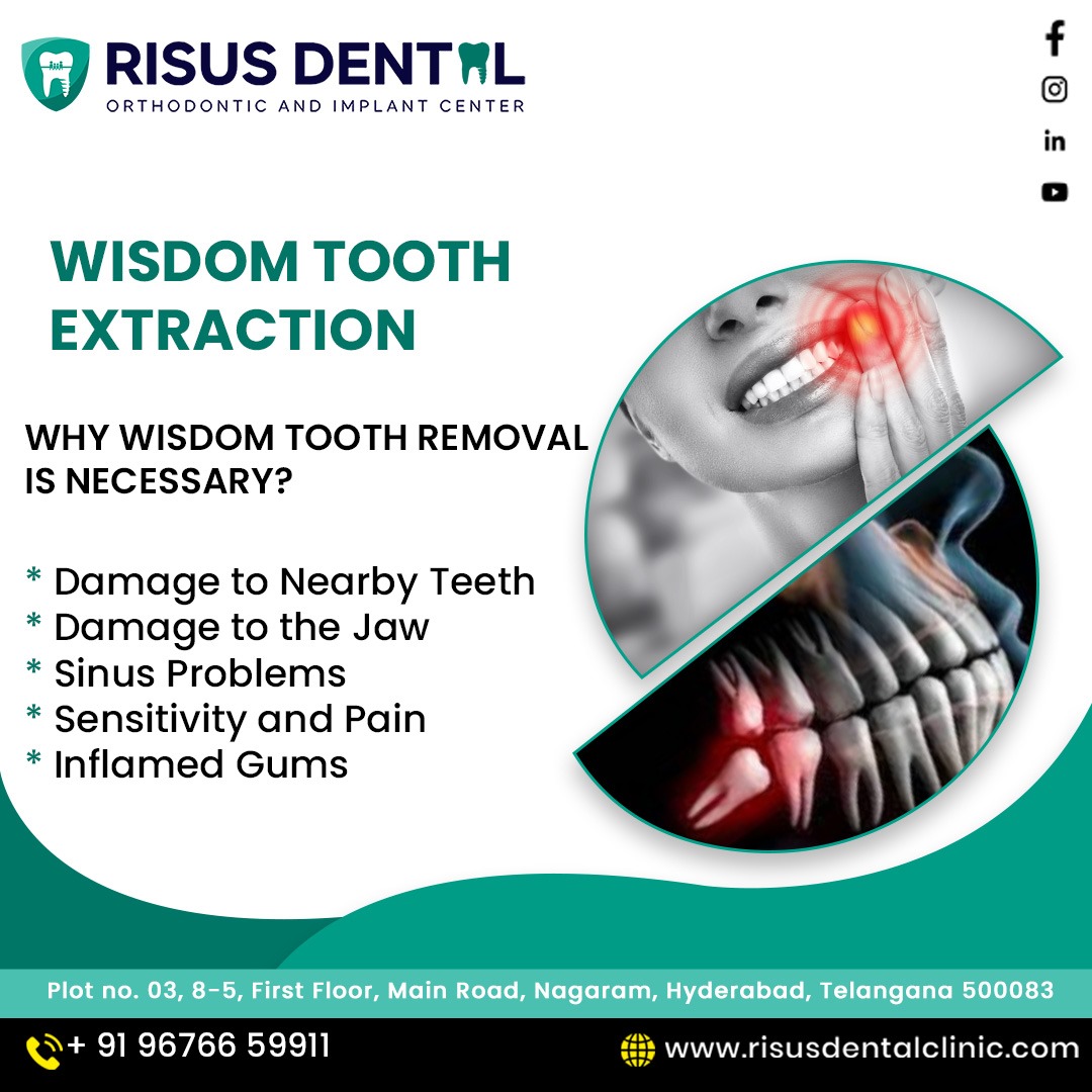  Wisdom Tooth Removal Treatment In Nagaram, Hyderabad | RISUS DENTAL