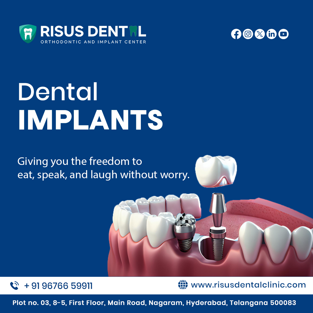  Best dental implants in nagaram | risus dental clinic