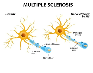  Multiple Sclerosis in Gurgaon