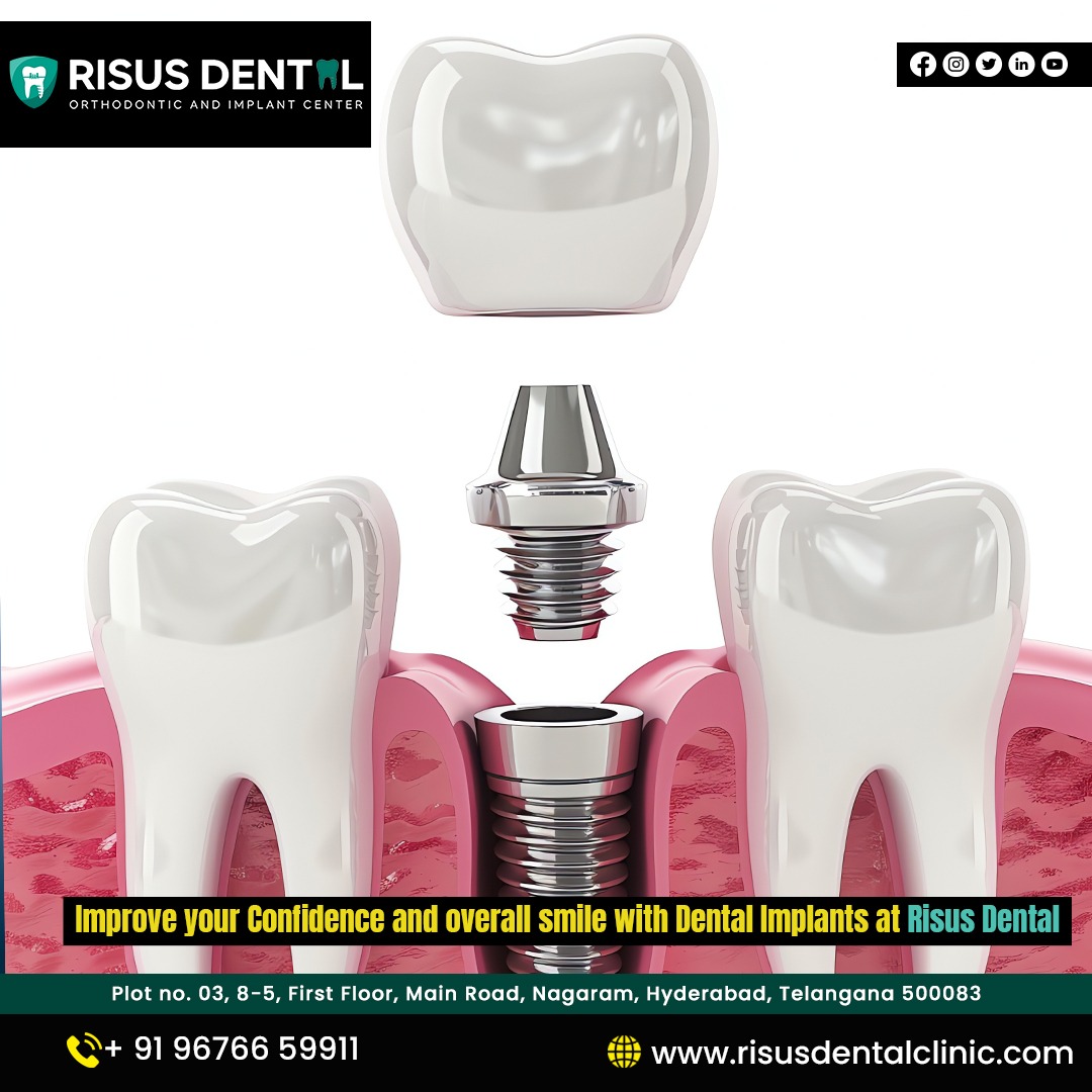  Top Dental Implants Treatment in Hyderabad | Risus Dental, Nagaram