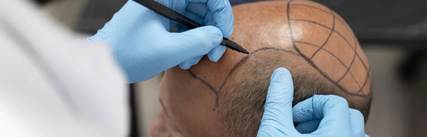  Best Hair Transplant Clinic in Gurgaon | Citrine Clinic