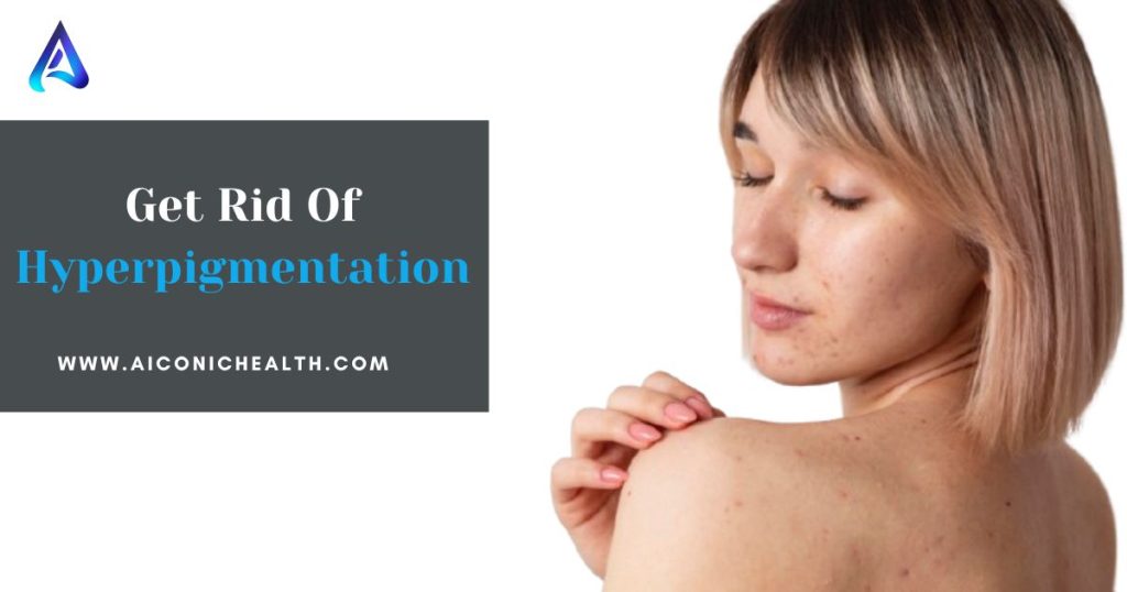  How To Get Rid Of Hyperpigmentation