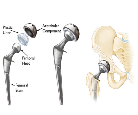  Best Hip Replacement Doctor In jaipur