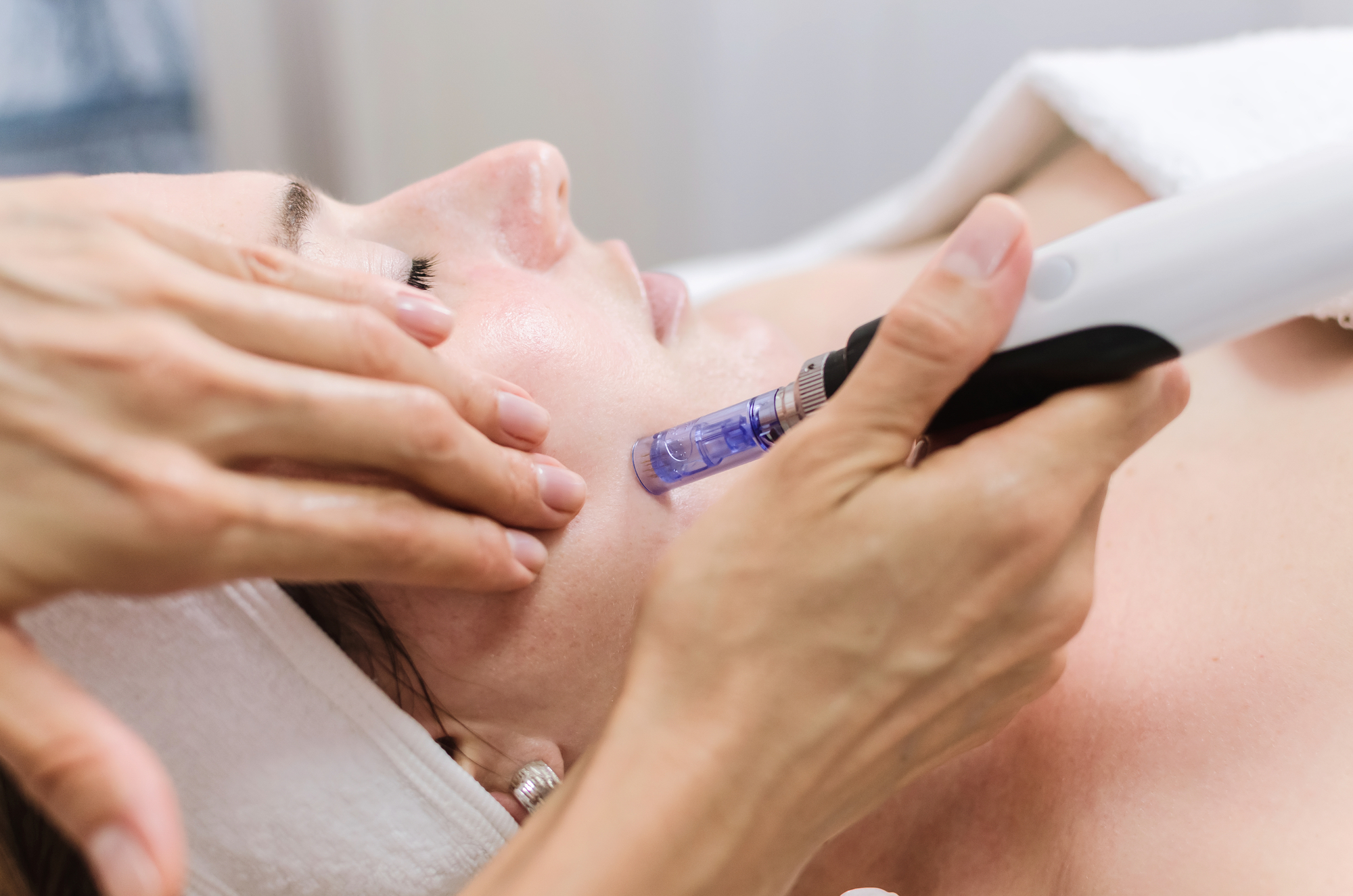  Verjüngen Sie Ihre Haut mit Microneedling | Aerzte-laserzentrum