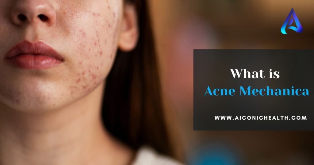  What is Acne Mechanica?